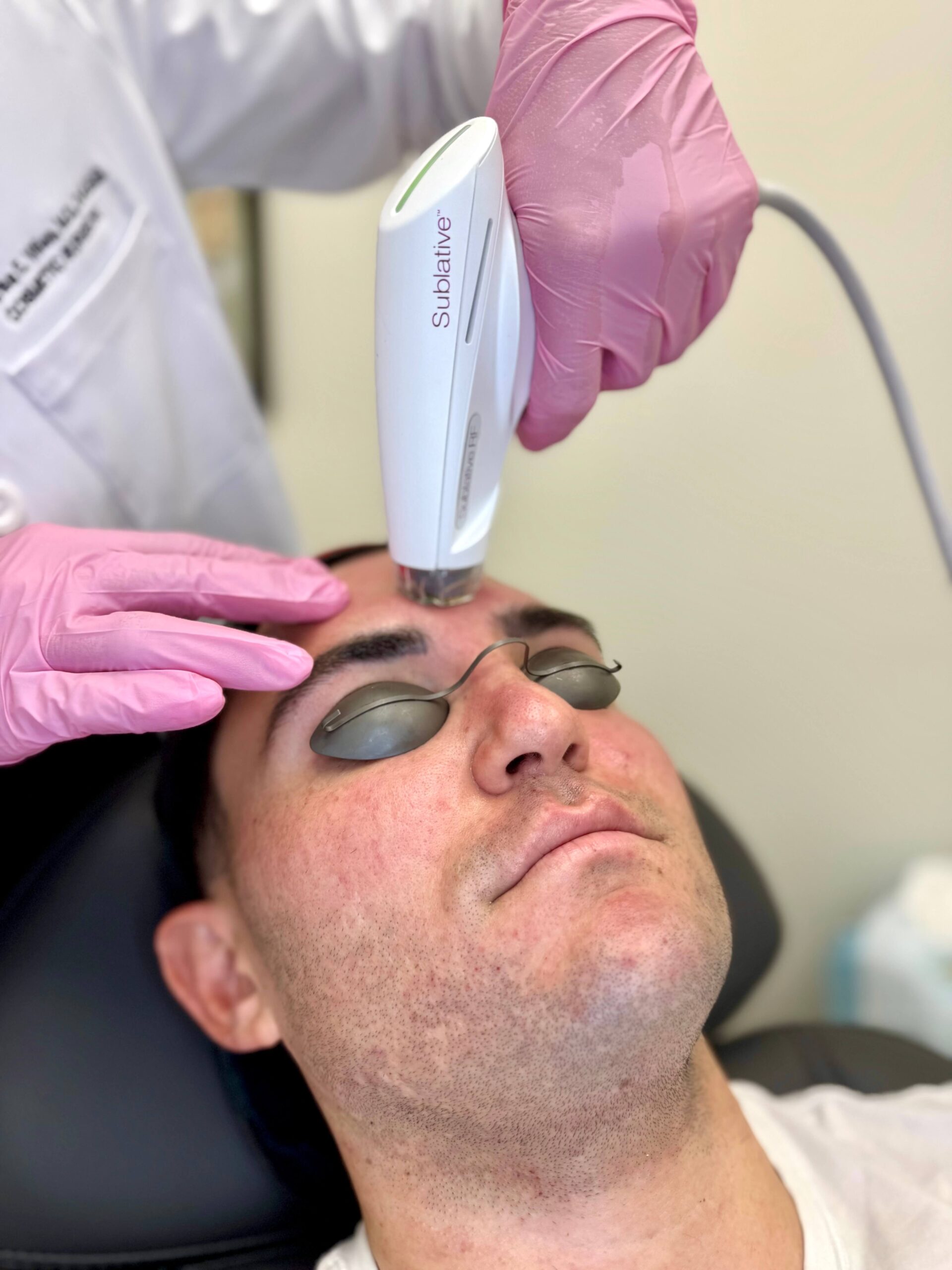 Radiofrequency Microneedling