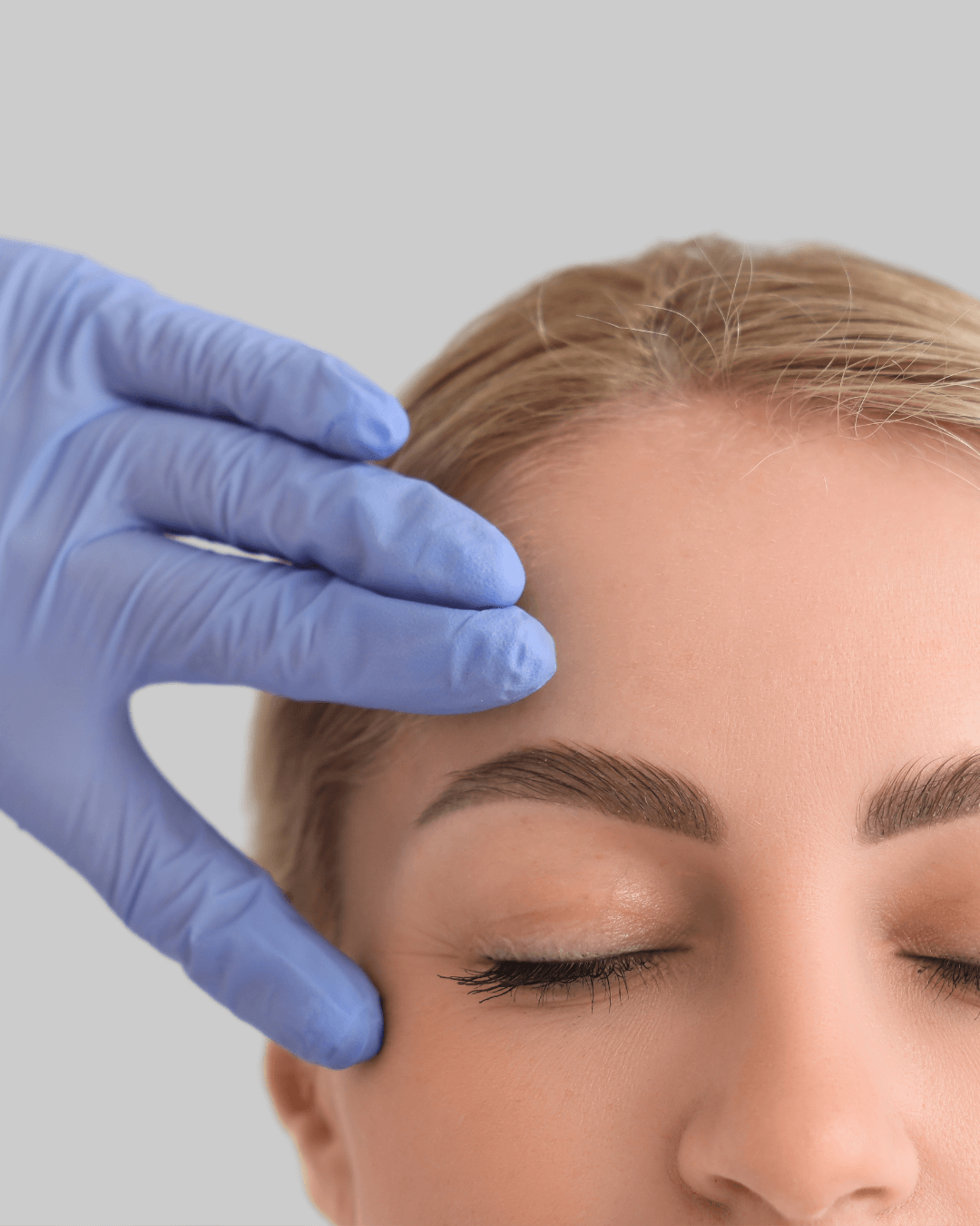 Upper and Lower Eyelid Blepharoplasty