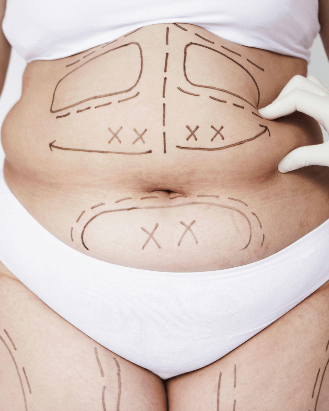 Liposuction with Renuvion